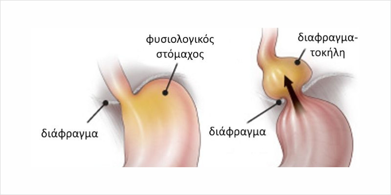διαφραγματοκήλη