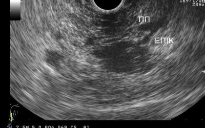 Intraductal papillary mucinous neoplasm (IPMN)